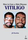 How to Cure a Skin Disease VitiligoHow to Cure a Skin Disease Vitiligo