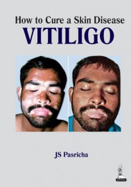How to Cure a Skin Disease VitiligoHow to Cure a Skin Disease Vitiligo
