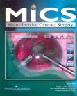 MICS Micro-Incision Cataract Surgery